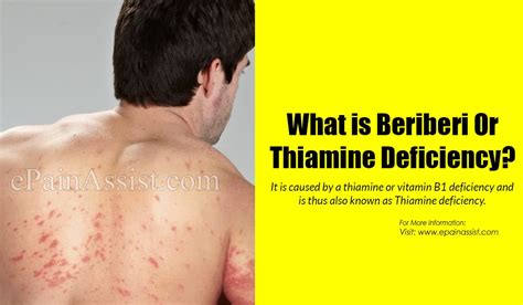 beriberi pictures|Beriberi Symptoms: What You Need to Know About Thiamine Deficiency.